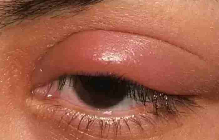 What is the Fastest Way to Heal a Swollen Eyelid_ (1)