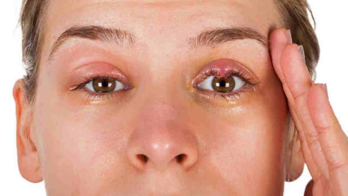 What is the Fastest Way to Heal a Swollen Eyelid?